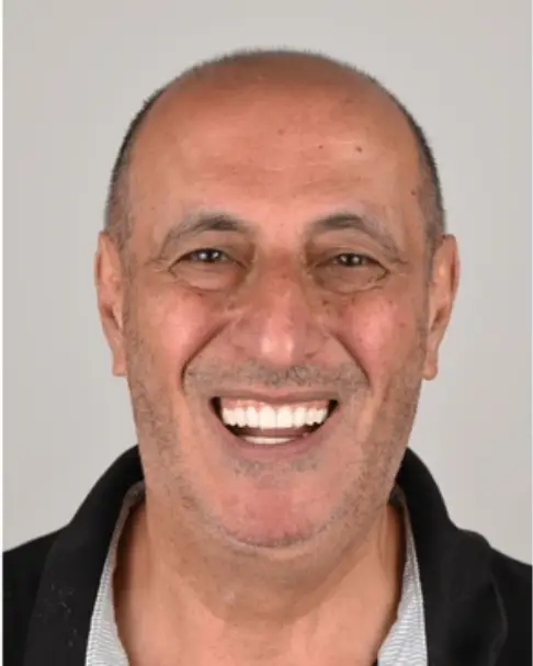 عکس قبل و بعد ایمپلنت دندان