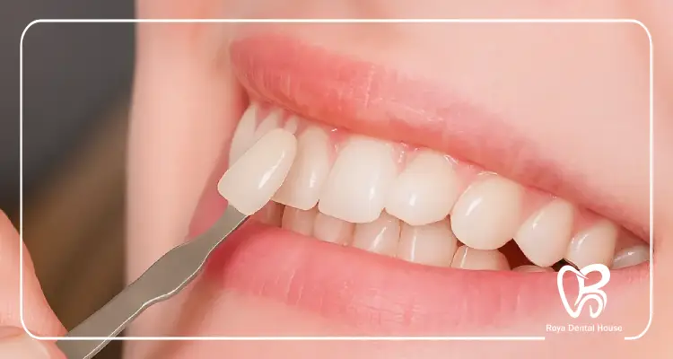 مراقبتهای بعد از لمینت دندان چیست؟