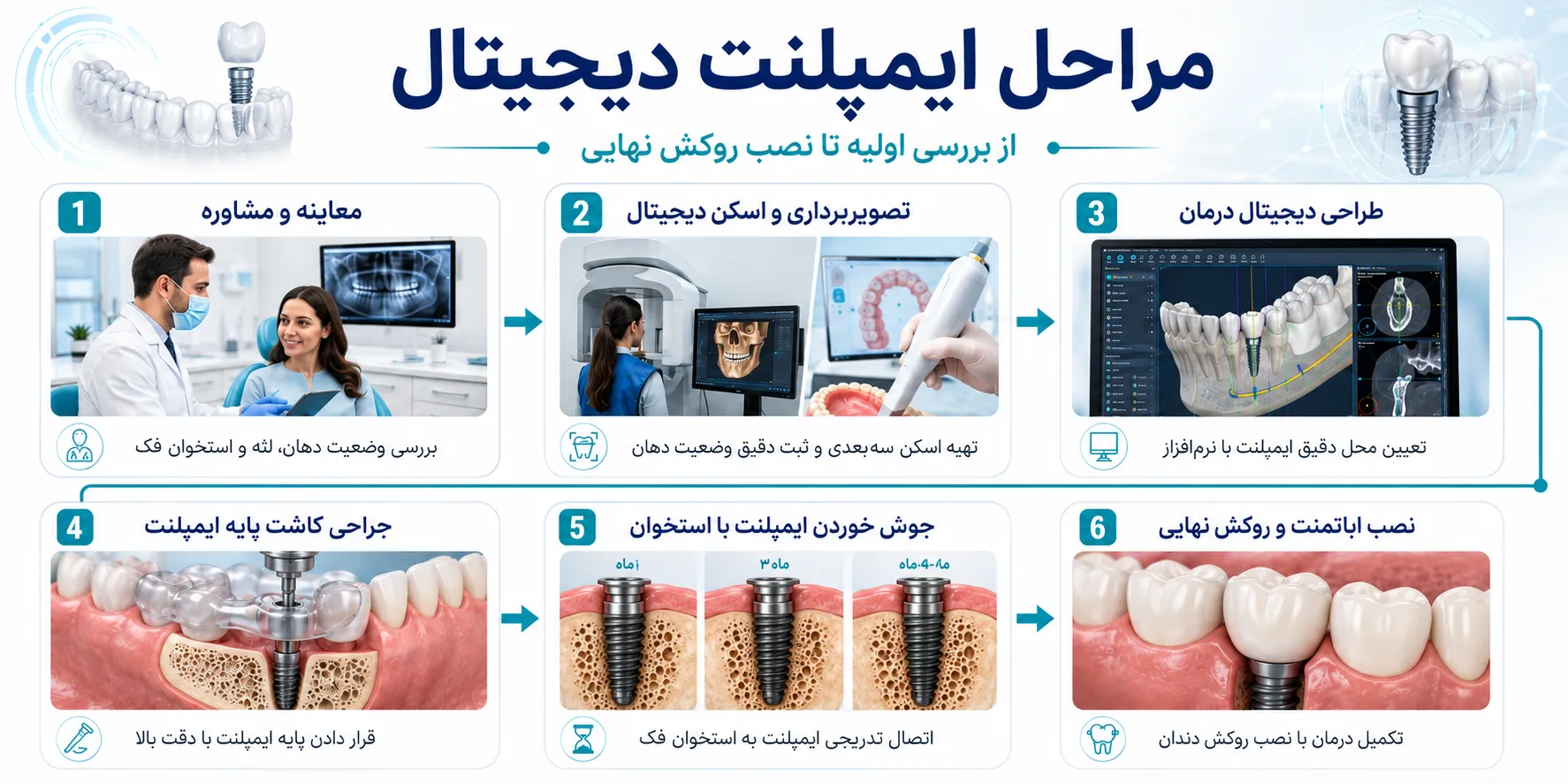 مراحل ایمپلنت دیجیتال