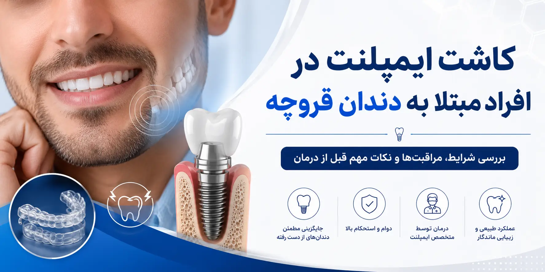 کاشت ایمپلنت در افراد مبتلا به دندان قروچه