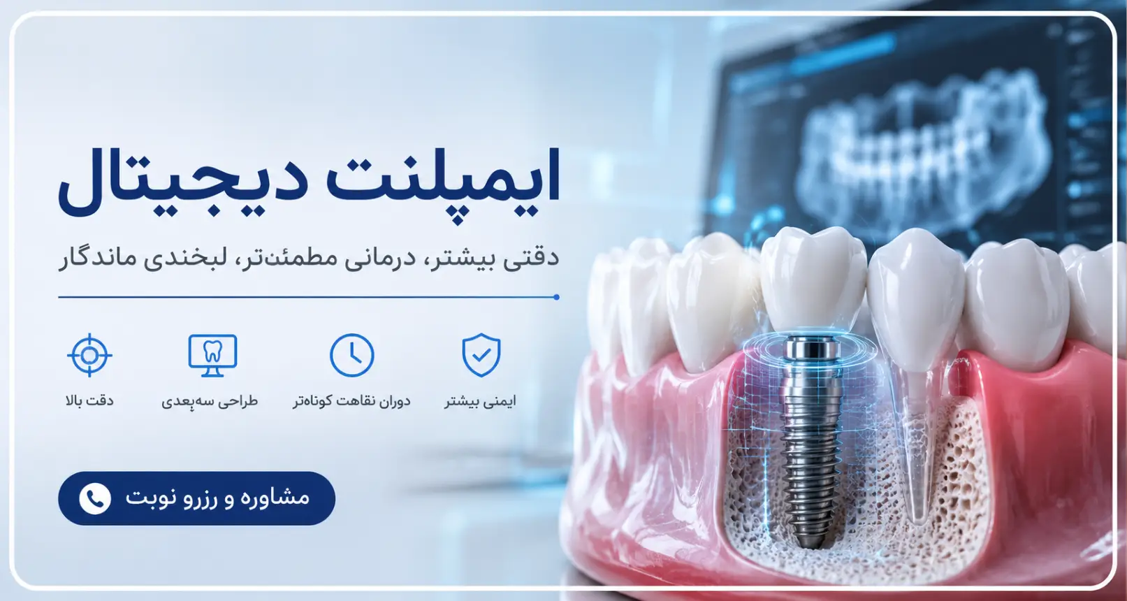 ایمپلنت دیجیتال