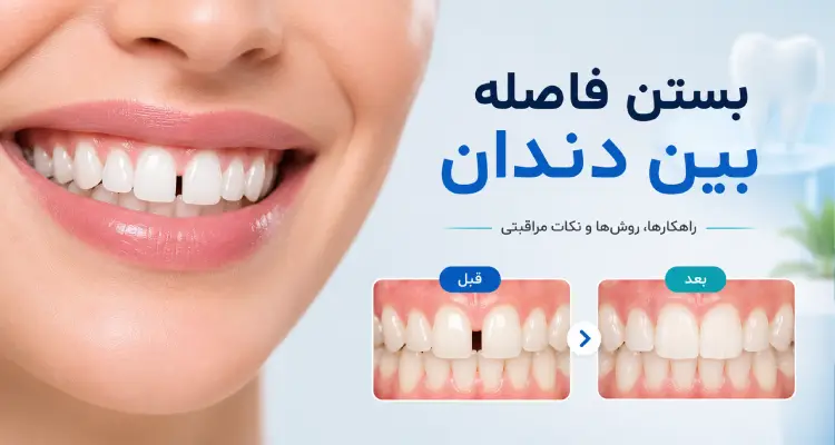 بستن فاصله بین دندان