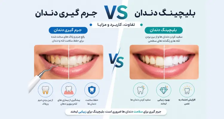 فرق بلیچینگ و جرم گیری دندان