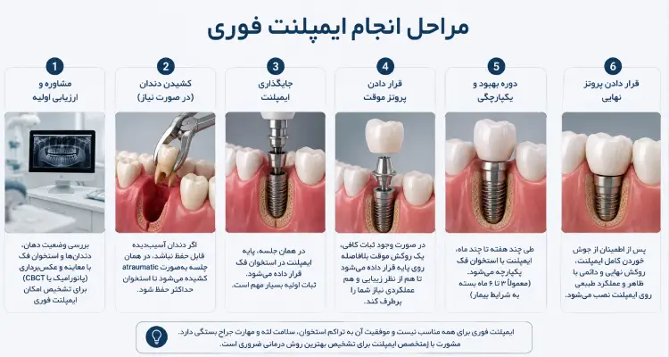 مراحل انجام ایمپلنت فوری