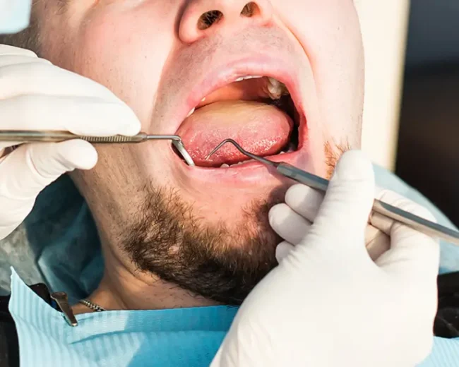 نحوه خوابیدن بعد از جراحی دندان عقل
