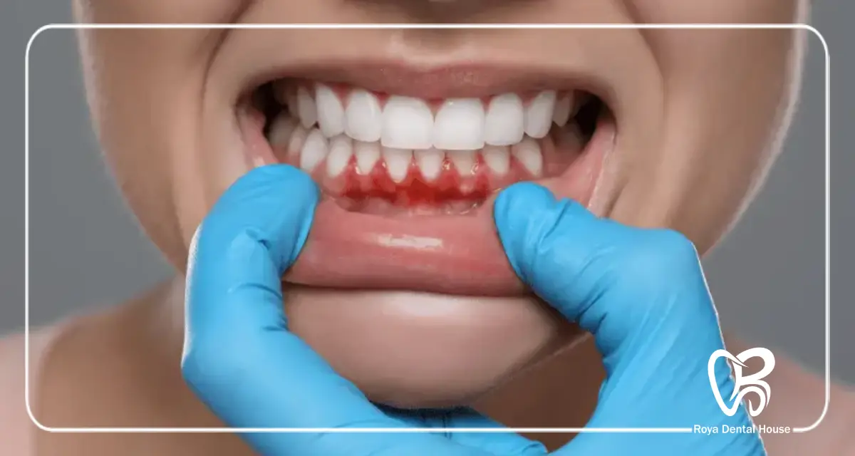 چه زمانی به جراحی لثه نیاز است؟